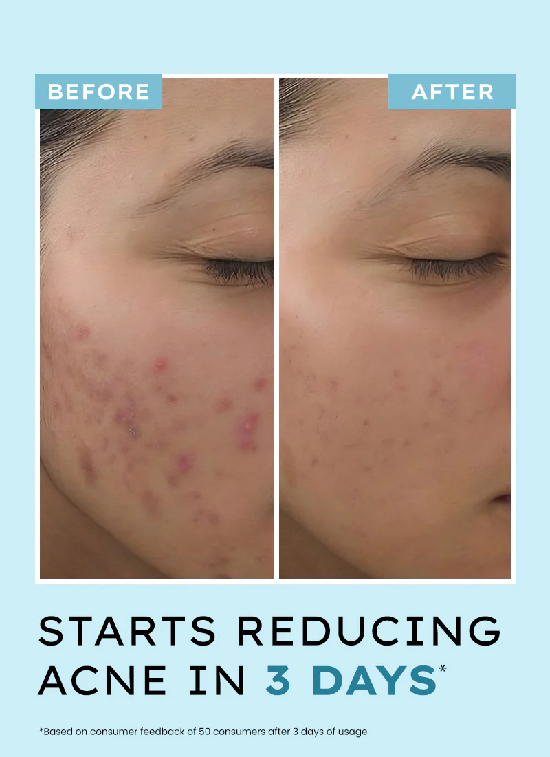 Anti Acne Face Serum with 10% Azelaic Acid & 2% Salicylic Acid - 30 ml - Image 5